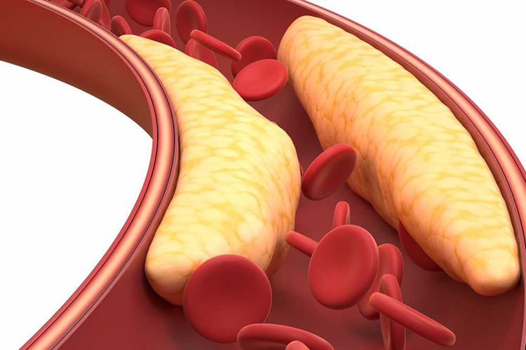 Colesterol y triglicéridos